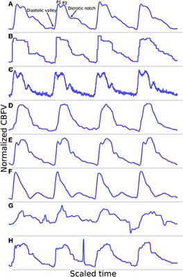 Algorithm for Reliable Detection of Pulse Onsets in Cerebral Blood Flow Velocity Signals